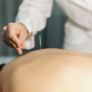 7 Real Facts To Know About Acupuncture Treatment