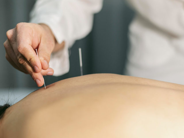 7 Real Facts To Know About Acupuncture Treatment