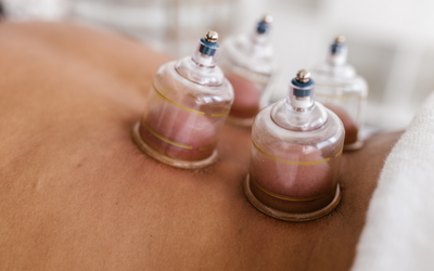 What Is Cupping Therapy and Does It Work?