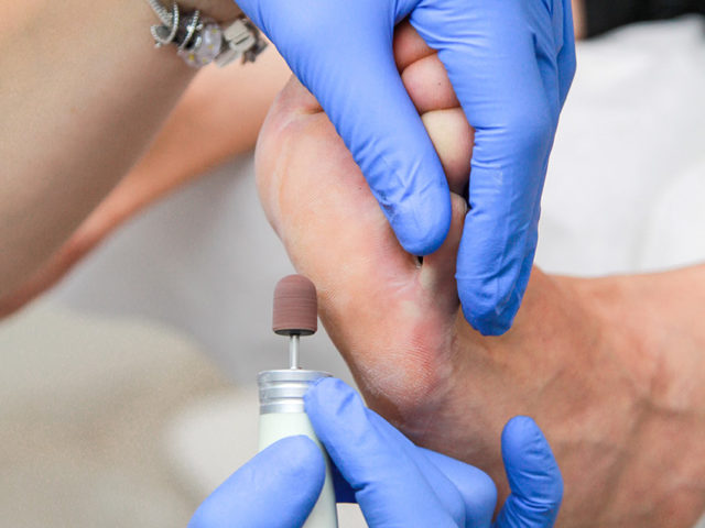 Comprehensive Chiropody Treatment in Brampton: Your Path to Healthy Feet